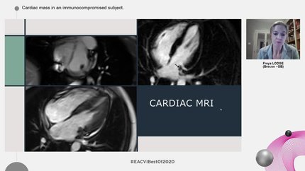 Cardiac mass in an immunocompromised subject.