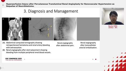 Hyperperfusion Injury after Percutaneous Transluminal Renal Angioplasty for Renovascular Hypertension as Sequelae of Neuroblastoma.
