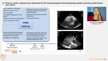 Primary cardiac angiosarcoma diagnosed by 3D transesophageal echocardiography guided endomyocardial biopsy case report.