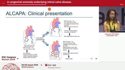 A congenital anomaly underlying mitral valve disease.