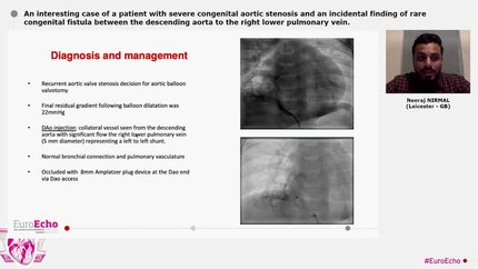 An interesting case of a patient with severe congenital aortic stenosis and an incidental finding of rare congenital fistula between the descending aorta to the right lower pulmonary vein.