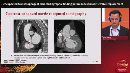 Unexpected transesophageal echocardiographic finding before bicuspid aortic valve replacement