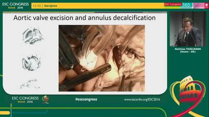 Anatomical pitfalls in AV surgery