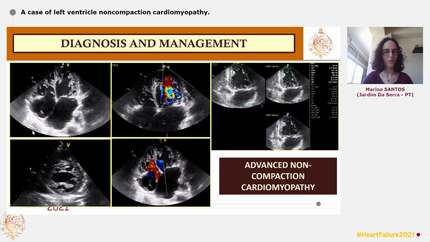 A case of left ventricle noncompaction cardiomyopathy.