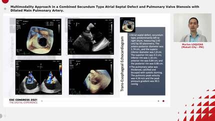 Multimodality Approach in a Combined Secundum Type Atrial Septal Defect and Pulmonary Valve Stenosis with Dilated Main Pulmonary Artery.
