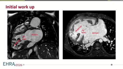 Jumping through the hoops of challenging anatomical barriers: ablation of "typical" atrial flutter in a patient with complex congenital heart disease and situs inversus