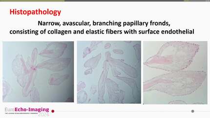 A very rare case of right ventricular papillary fibroelastoma - a multi-modality image management