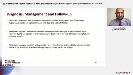 Ventricular septal rupture a rare but important complication of acute myocardial infarction.