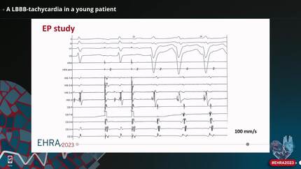 A LBBB-tachycardia in a young patient