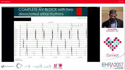 Ablation of post-Maze arrhythmias.