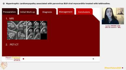Hypertrophic cardiomyopathy associated with parvovirus B19 viral myocarditis treated with telbivudine.