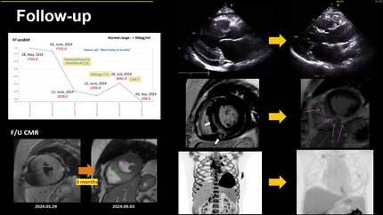 Utilizing CMR parametric mapping to diagnose and monitor progressive LVH in acute lymphoblastic leukemia relapse treated with CAR-T therapy