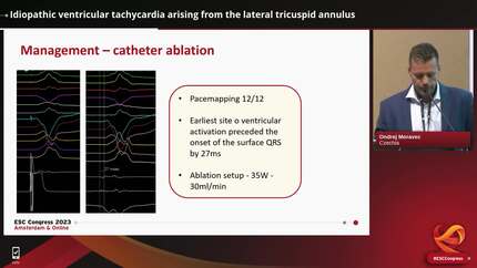 Idiopathic ventricular tachycardia arising from the lateral tricuspid annulus
