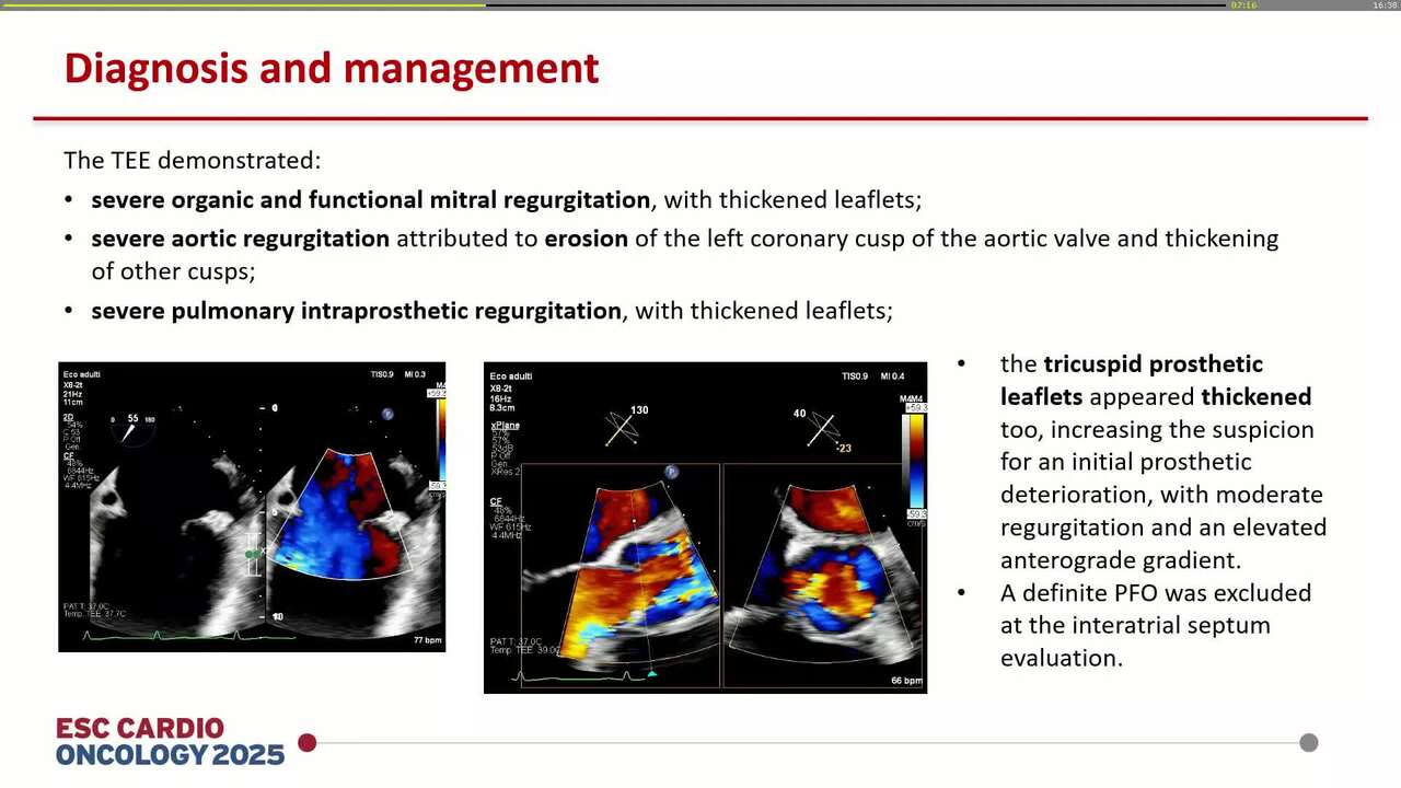 Simultaneous deterioration of left heart valves and right heart valvular prostheses: a rare case of carcinoid syndrome relapse