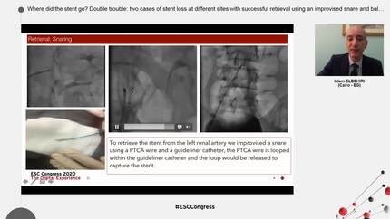 Where did the stent go? Double trouble: two cases of stent loss at different sites with successful retrieval using an improvised snare and balloon en bloc technique.