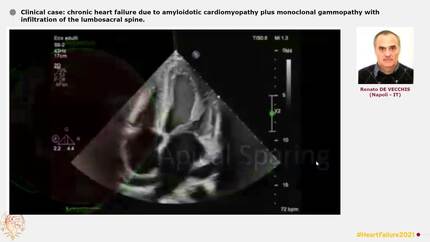 Clinical case: chronic heart failure due to amyloidotic cardiomyopathy plus monoclonal gammopathy with infiltration of the lumbosacral spine.