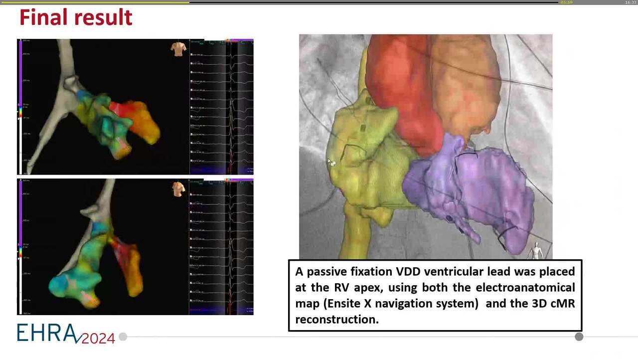 Challenging pacemaker implantation in a patient with complex congenital heart disease: use of additional imaging tools to overcome technical issues