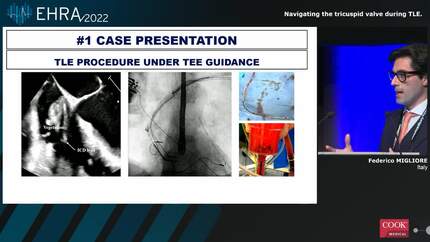 Current challenges in Transvenous Lead Extraction and how to overcome them successfully