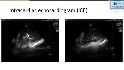 Fluoroless dual-chamber pacemaker implantation in a pregnant woman with ventricular standstill