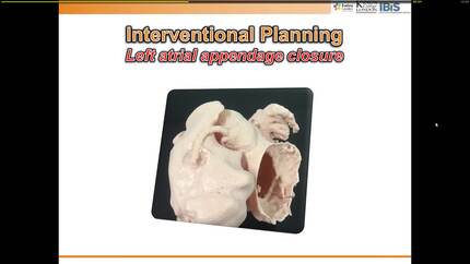 3D printing for planning interventions.
