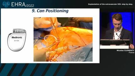 Innovations in implantable cardioverter-defibrillator (ICD) therapy: the extravascular ICD 
