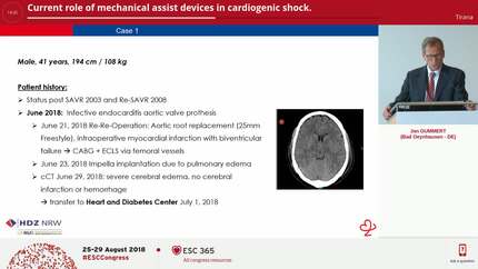 Current role of mechanical assist devices in cardiogenic shock.