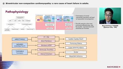 Biventricular non-compaction cardiomyopathy: a rare cause of heart failure in adults.
