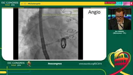 Transcatheter tricuspid valve-in-valve implantation into a failing surgical bioprosthesis