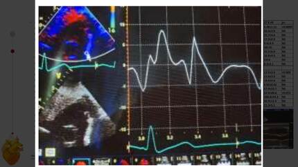Right ventricle in arterial hypertension and A and B stage heart failure.