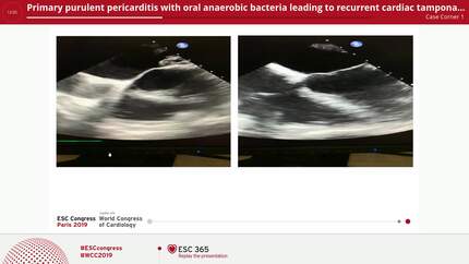 Primary purulent pericarditis with oral anaerobic bacteria leading to recurrent cardiac tamponade.