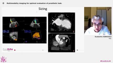 Multimodality imaging for prosthetic valve dysfunction evaluation 