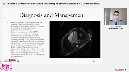 Idiopathic Constrictive Pericarditis Presenting as Isolated Ascites in a 31 year-old-male.