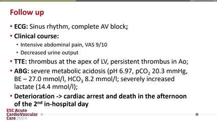 A rare cause of the inferior ST-elevation myocardial infarction complicated with intermittent complete heart block