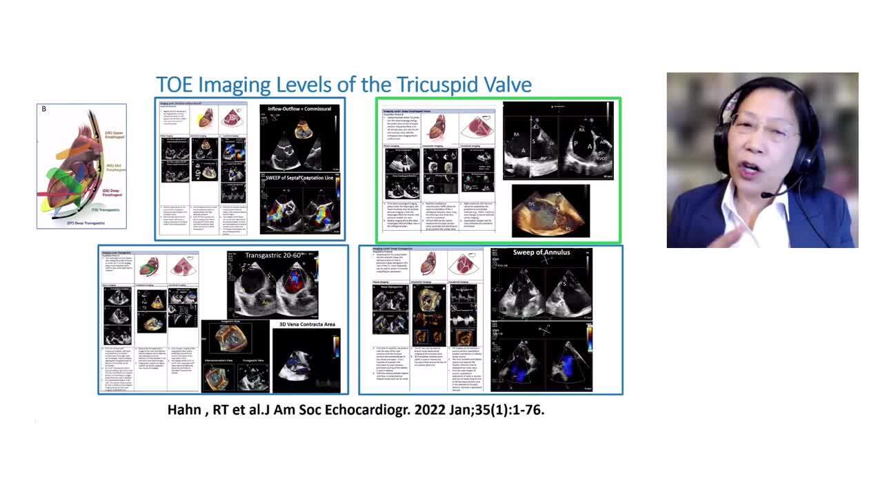 Three-dimensional transoesophageal echocardiography: how to use and when to use in valvular heart disease