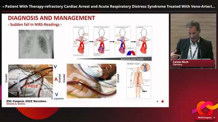 Patient With Therapy-refractory Cardiac Arrest and Acute Respiratory Distress Syndrome Treated With Veno-Arterial-Venous Extracorporeal Membrane Oxygenation and Left-Ventricular Impella CP®
