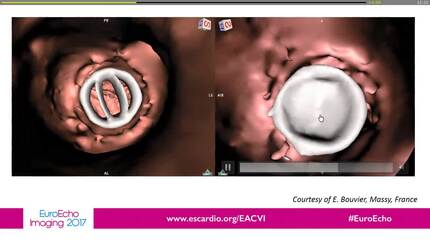 Echo in prosthetic valves: when it matters!