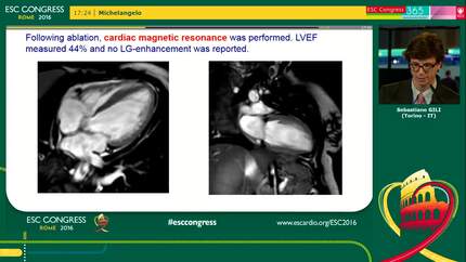 A right ventricular outflow tract focus triggering tachycardiomyopathy in a peripartum patient exposed to radiation and chemotherapy