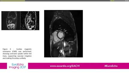 An unusual cause of acute coronary syndrome