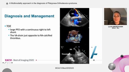 A Multimodality approach in the diagnosis of Platypnea-Orthodeoxia syndrome.