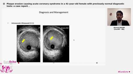 Plaque erosion causing acute coronary syndrome in a 41-year-old female with previously normal diagnostic tests: a case report.
.