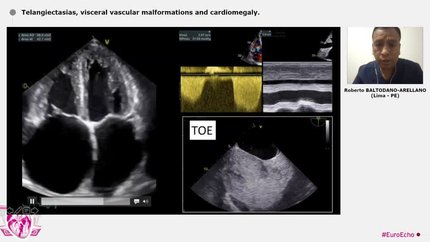 Telangiectasias, visceral vascular malformations and cardiomegaly.