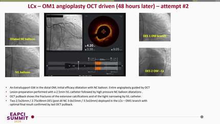 Double burr entrapment in a calcified coronary lesion in a patient with acute coronary syndrome