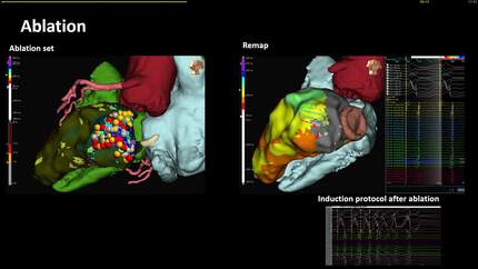 Multimodality approach to the No-Entry Ventricle for VT ablation: first European experience of the RA-to-LV percutaneous access 