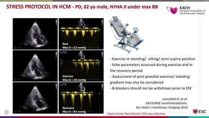 Redefining hypertrophic cardiomyopathy in the myosin inhibitor era