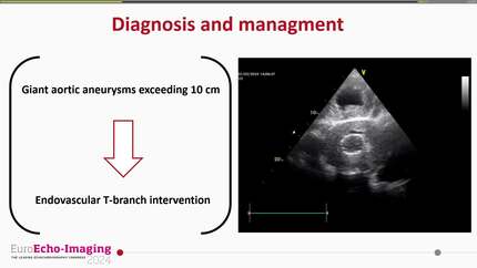 Surprising echocardiographic qualification for vascular surgery - the twin heart syndrome.