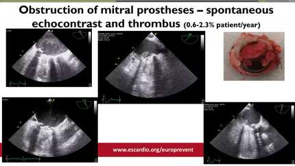 Evaluation of the patient after heart valve replacement.