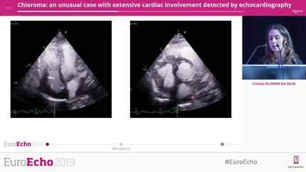 Chloroma: an unusual case with extensive cardiac involvement detected by echocardiography