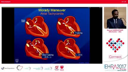 The world of entrainment and stimulation manoeuvers for differentiation between SVTs.