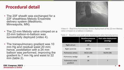 Intravascular lithotripsy facilitates transcatheter pulmonary valve replacement in a patient with Tetralogy of Fallot and a severely calcified pulmonary homograft 