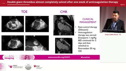 Double giant thrombus almost completely solved after one week of anticoagulation therapy